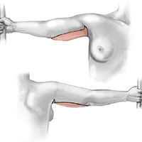 brachioplastica-braccia